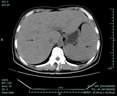 Hemophagocytic Lymphohistiocytosis Secondary to Disseminated Histoplasmosis in HIV Seronegative Patients: A Case Report and Review of the Literature